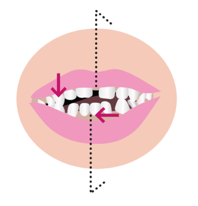 Vous pouvez consulter avant 6 ans en cas de déviation entre les dents du haut et du bas - Docteur Petitprez - Orthodontiste à Estaires.